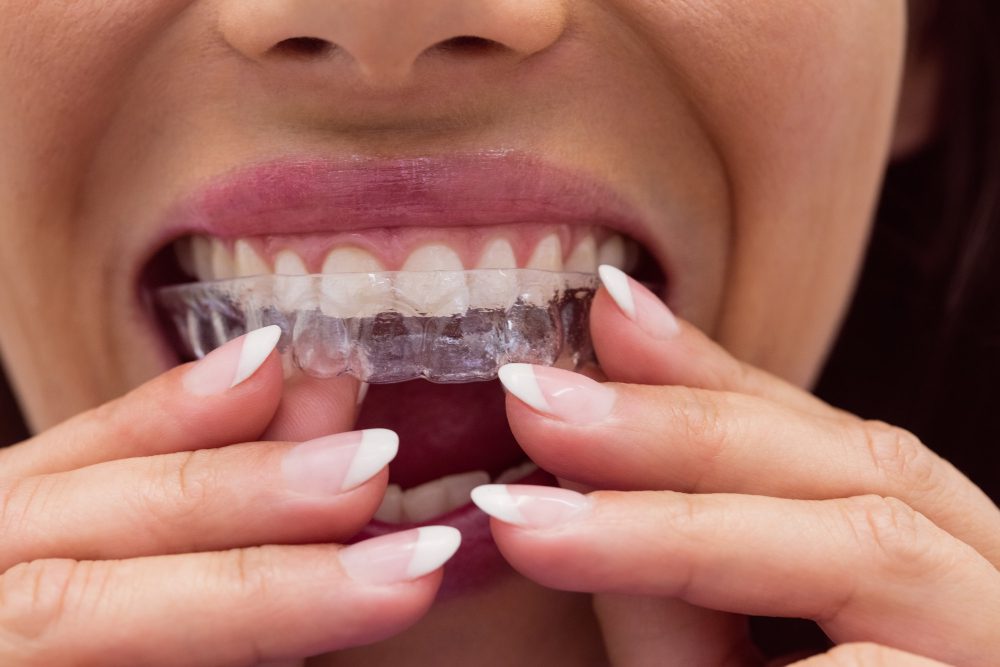 How Long Does Invisalign Take?