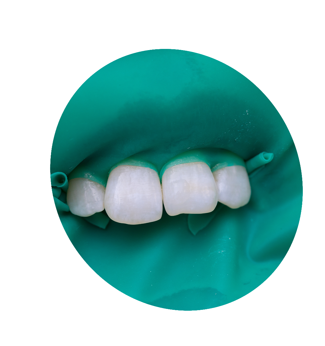 dental bonding bucktown chicago