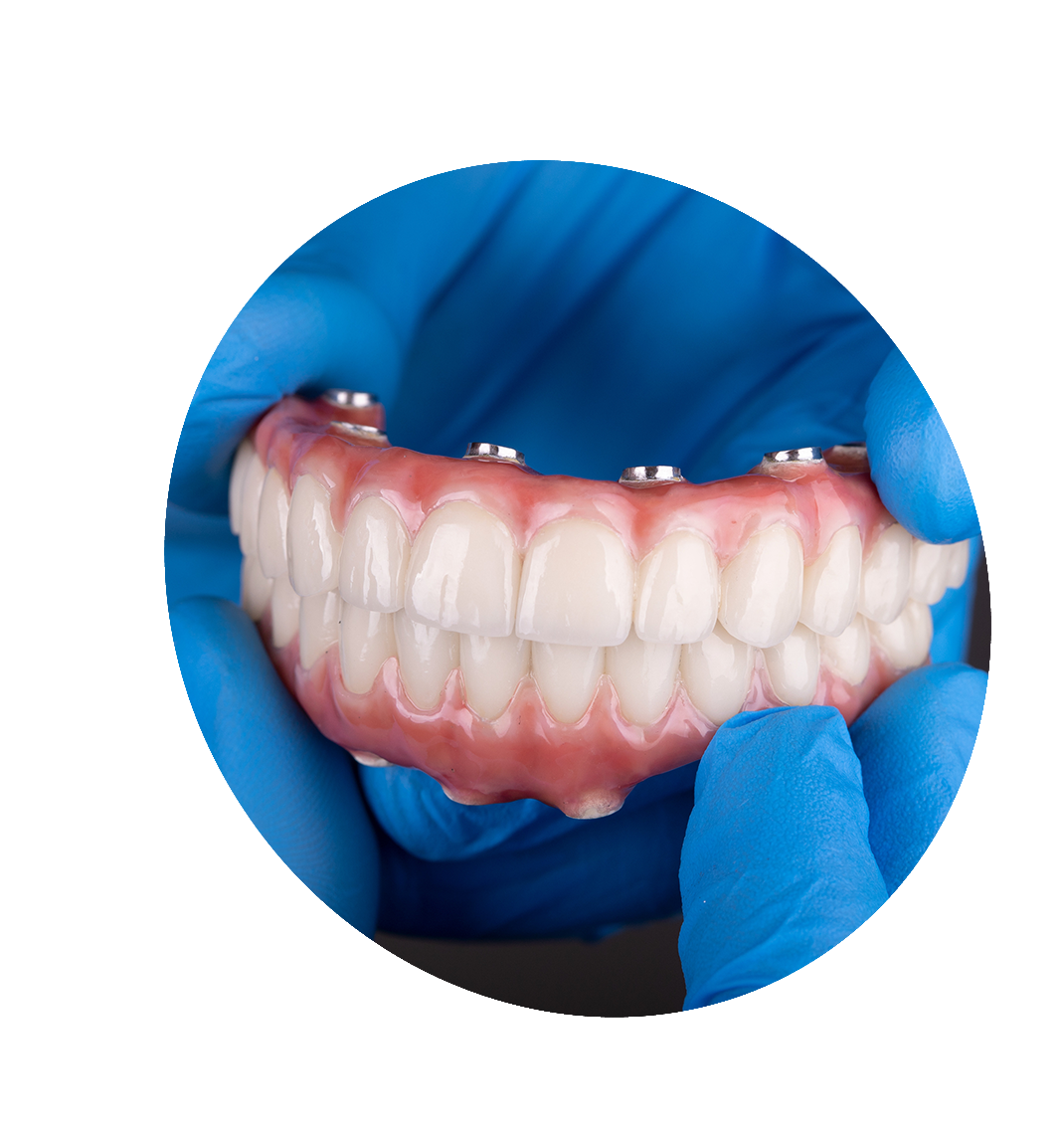 implant supported crown bucktown chicago