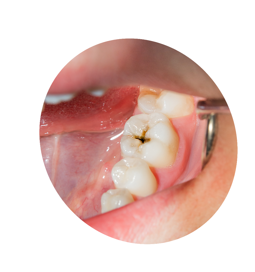 tooth extraction bucktown chicago