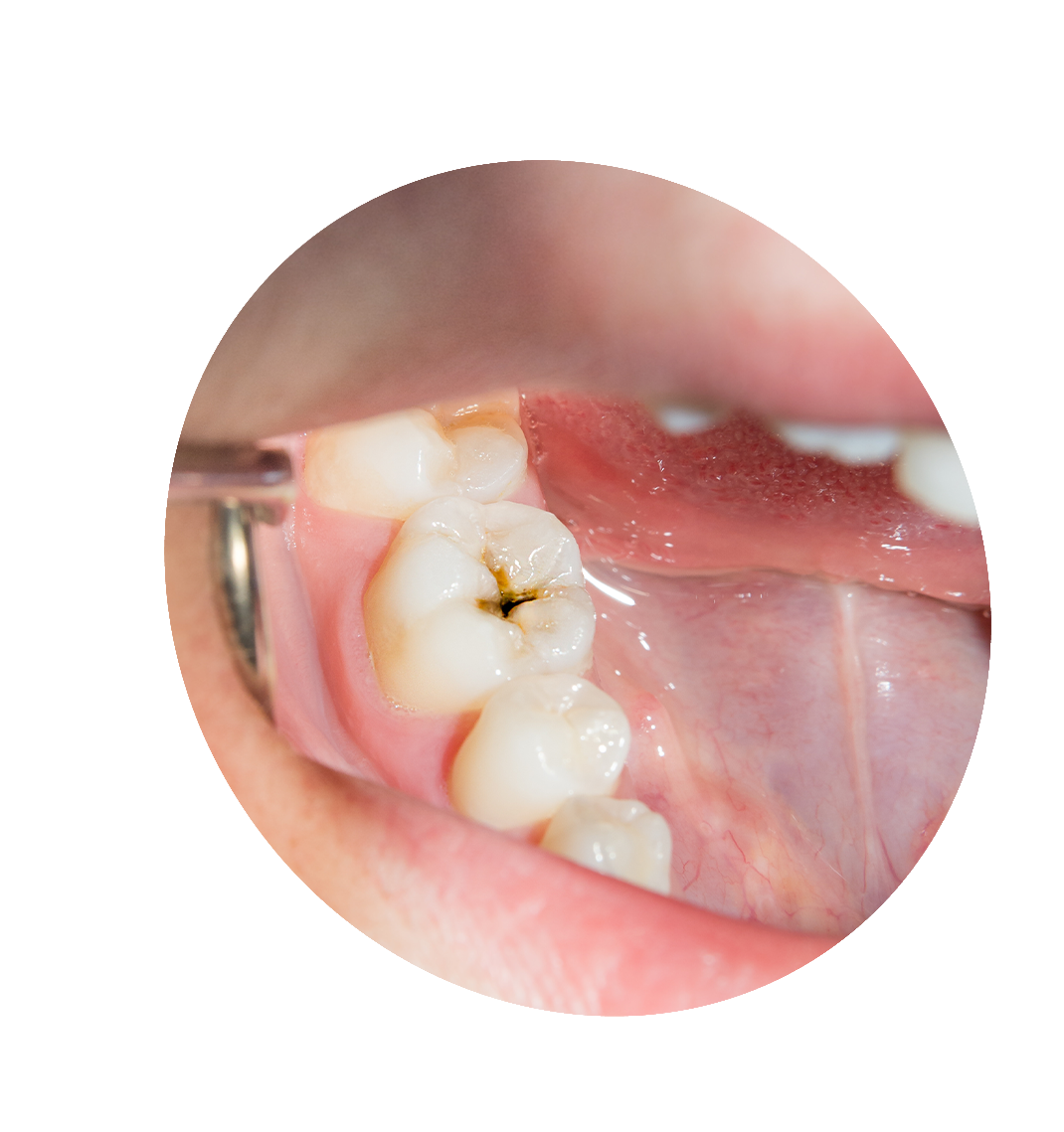 tooth extraction bucktown chicago